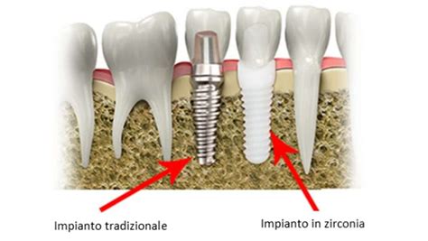 Ossido di Zirconio: Materiale Biocompatibile per Impianti Dentali Durabili!